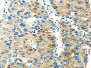 The image on the left is immunohistochemistry of paraffin-embedded Human liver cancer tissue using CSB-PA069189(PDPN Antibody) at dilution 1/20, on the right is treated with synthetic peptide. (Original magnification: ×200)