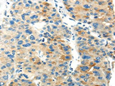 The image on the left is immunohistochemistry of paraffin-embedded Human liver cancer tissue using CSB-PA069189(PDPN Antibody) at dilution 1/20, on the right is treated with synthetic peptide. (Original magnification: ×200)