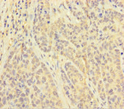 Immunohistochemistry of paraffin-embedded human ovarian cancer using CSB-PA06919A0Rb at dilution of 1:100