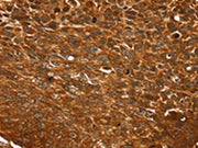 The image on the left is immunohistochemistry of paraffin-embedded Human esophagus cancer tissue using CSB-PA069259(TCEB3B Antibody) at dilution 1/25, on the right is treated with synthetic peptide. (Original magnification: ×200)