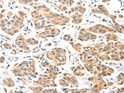 The image on the left is immunohistochemistry of paraffin-embedded Human breast cancer tissue using CSB-PA069429(ADCK1 Antibody) at dilution 1/40, on the right is treated with fusion protein. (Original magnification: ×200)