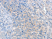 The image on the left is immunohistochemistry of paraffin-embedded Human cervical cancer tissue using CSB-PA069457(ADAM10 Antibody) at dilution 1/35, on the right is treated with fusion protein. (Original magnification: ×200)