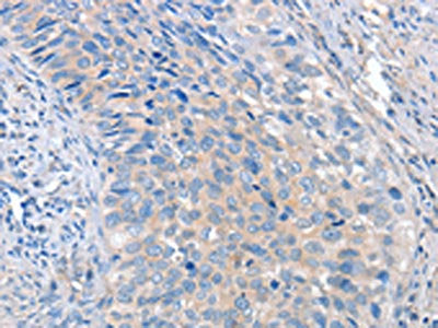 The image on the left is immunohistochemistry of paraffin-embedded Human cervical cancer tissue using CSB-PA069457(ADAM10 Antibody) at dilution 1/35, on the right is treated with fusion protein. (Original magnification: ×200)