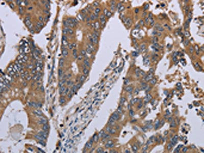 The image on the left is immunohistochemistry of paraffin-embedded Human colon cancer tissue using CSB-PA069966(NLRP12 Antibody) at dilution 1/30, on the right is treated with synthetic peptide. (Original magnification: ×200)