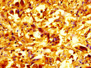 IHC image of CSB-PA06997A0Rb diluted at 1:100 and staining in paraffin-embedded human melanoma performed on a Leica BondTM system. After dewaxing and hydration, antigen retrieval was mediated by high pressure in a citrate buffer (pH 6.0). Section...