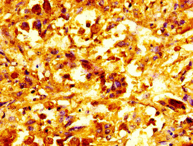 IHC image of CSB-PA06997A0Rb diluted at 1:100 and staining in paraffin-embedded human melanoma performed on a Leica BondTM system. After dewaxing and hydration, antigen retrieval was mediated by high pressure in a citrate buffer (pH 6.0). Section...