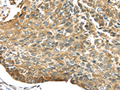 The image on the left is immunohistochemistry of paraffin-embedded Human esophagus cancer tissue using CSB-PA070315(TRIM16 Antibody) at dilution 1/30, on the right is treated with fusion protein. (Original magnification: ×200)