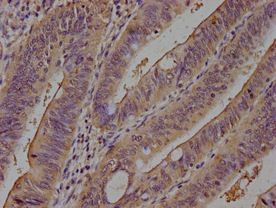 IHC image of CSB-PA07039A0Rb diluted at 1:100 and staining in paraffin-embedded human colon cancer performed on a Leica BondTM system. After dewaxing and hydration, antigen retrieval was mediated by high pressure in a citrate buffer (pH 6.0). Sect...
