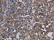 The image on the left is immunohistochemistry of paraffin-embedded Human ovarian cancer tissue using CSB-PA070468(LBR Antibody) at dilution 1/50, on the right is treated with fusion protein. (Original magnification: ×200)