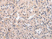 The image on the left is immunohistochemistry of paraffin-embedded Human liver cancer tissue using CSB-PA070545(IGF1 Antibody) at dilution 1/30, on the right is treated with synthetic peptide. (Original magnification: ×200)