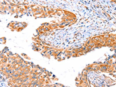 The image on the left is immunohistochemistry of paraffin-embedded Human cervical cancer tissue using CSB-PA070672(AP1B1 Antibody) at dilution 1/70, on the right is treated with synthetic peptide. (Original magnification: ×200)