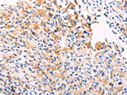 The image on the left is immunohistochemistry of paraffin-embedded Human gastic cancer tissue using CSB-PA070773(PGBD1 Antibody) at dilution 1/20, on the right is treated with fusion protein. (Original magnification: ×200)