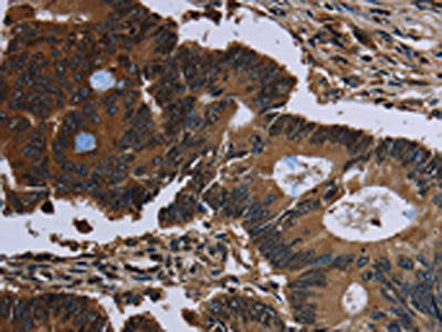 The image on the left is immunohistochemistry of paraffin-embedded Human colon cancer tissue using CSB-PA071110(IRGM Antibody) at dilution 1/60, on the right is treated with fusion protein. (Original magnification: ×200)