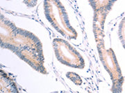 The image on the left is immunohistochemistry of paraffin-embedded Human colon cancer tissue using CSB-PA071125(VHL Antibody) at dilution 1/40, on the right is treated with fusion protein. (Original magnification: ×200)
