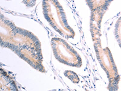 The image on the left is immunohistochemistry of paraffin-embedded Human colon cancer tissue using CSB-PA071125(VHL Antibody) at dilution 1/40, on the right is treated with fusion protein. (Original magnification: ×200)