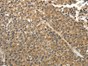 The image on the left is immunohistochemistry of paraffin-embedded Human liver cancer tissue using CSB-PA071225(EIF2AK3 Antibody) at dilution 1/30, on the right is treated with fusion protein. (Original magnification: ×200)