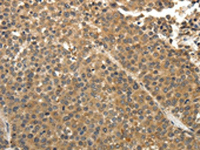 The image on the left is immunohistochemistry of paraffin-embedded Human liver cancer tissue using CSB-PA071225(EIF2AK3 Antibody) at dilution 1/30, on the right is treated with fusion protein. (Original magnification: ×200)
