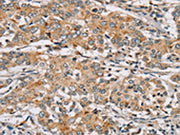 The image on the left is immunohistochemistry of paraffin-embedded Human liver cancer tissue using CSB-PA071446(RAB24 Antibody) at dilution 1/45, on the right is treated with synthetic peptide. (Original magnification: ×200)