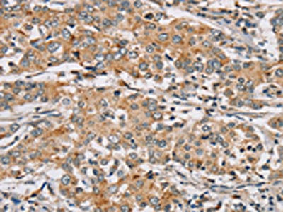 The image on the left is immunohistochemistry of paraffin-embedded Human liver cancer tissue using CSB-PA071446(RAB24 Antibody) at dilution 1/45, on the right is treated with synthetic peptide. (Original magnification: ×200)