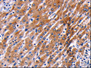 The image on the left is immunohistochemistry of paraffin-embedded Human liver cancer tissue using CSB-PA071472(PPP1R13B Antibody) at dilution 1/35, on the right is treated with synthetic peptide. (Original magnification: ×200)