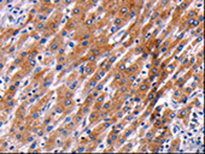 The image on the left is immunohistochemistry of paraffin-embedded Human liver cancer tissue using CSB-PA071472(PPP1R13B Antibody) at dilution 1/35, on the right is treated with synthetic peptide. (Original magnification: ×200)