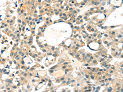 The image on the left is immunohistochemistry of paraffin-embedded Human breast cancer tissue using CSB-PA071515(RRAGA Antibody) at dilution 1/25, on the right is treated with fusion protein. (Original magnification: ×200)