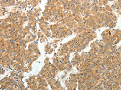 The image on the left is immunohistochemistry of paraffin-embedded Human liver cancer tissue using CSB-PA071725(GEMIN2 Antibody) at dilution 1/40, on the right is treated with synthetic peptide. (Original magnification: ×200)