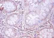 Immunohistochemistry of paraffin-embedded human colon cancer using CSB-PA07174A0Rb at dilution of 1:100