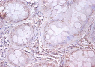 Immunohistochemistry of paraffin-embedded human colon cancer using CSB-PA07174A0Rb at dilution of 1:100