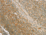 The image on the left is immunohistochemistry of paraffin-embedded Human ovarian cancer tissue using CSB-PA071831(PRKAA1 Antibody) at dilution 1/80, on the right is treated with synthetic peptide. (Original magnification: ×200)