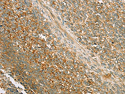 The image on the left is immunohistochemistry of paraffin-embedded Human ovarian cancer tissue using CSB-PA071831(PRKAA1 Antibody) at dilution 1/80, on the right is treated with synthetic peptide. (Original magnification: ×200)