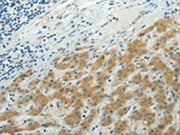 The image on the left is immunohistochemistry of paraffin-embedded Human liver cancer tissue using CSB-PA071884(NDRG2 Antibody) at dilution 1/50, on the right is treated with synthetic peptide. (Original magnification: ×200)
