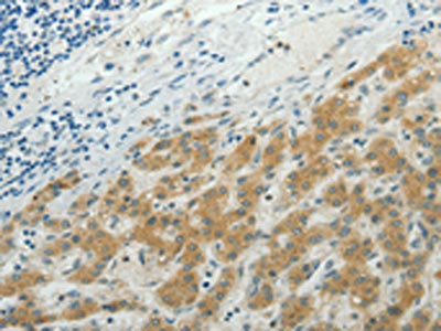 The image on the left is immunohistochemistry of paraffin-embedded Human liver cancer tissue using CSB-PA071884(NDRG2 Antibody) at dilution 1/50, on the right is treated with synthetic peptide. (Original magnification: ×200)