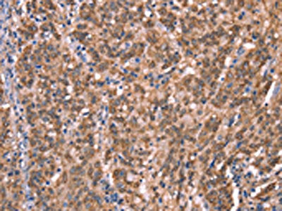 The image on the left is immunohistochemistry of paraffin-embedded Human gastic cancer tissue using CSB-PA072040(GCSAM Antibody) at dilution 1/40, on the right is treated with synthetic peptide. (Original magnification: ×200)