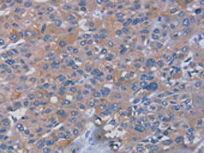 The image on the left is immunohistochemistry of paraffin-embedded Human liver cancer tissue using CSB-PA072418(RHEB Antibody) at dilution 1/25, on the right is treated with fusion protein. (Original magnification: ×200)