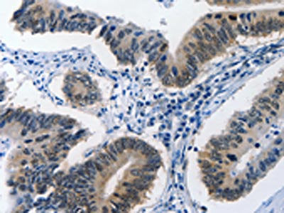 The image on the left is immunohistochemistry of paraffin-embedded Human colon cancer tissue using CSB-PA072508(BPIFB1 Antibody) at dilution 1/40, on the right is treated with synthetic peptide. (Original magnification: ×200)