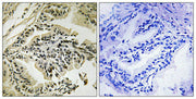 Immunohistochemical analysis of paraffin-embedded human prostate carcinoma tissue using PEK/PERK (Phospho-Thr982) antibody (left)or the same antibody preincubated with blocking peptide (right).