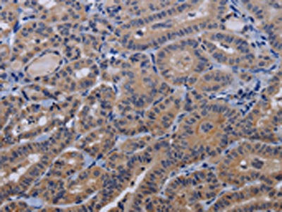 The image on the left is immunohistochemistry of paraffin-embedded Human thyroid cancer tissue using CSB-PA072616(TRPM8 Antibody) at dilution 1/30, on the right is treated with fusion protein. (Original magnification: ×200)