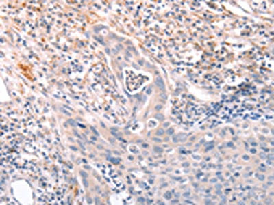The image on the left is immunohistochemistry of paraffin-embedded Human cervical cancer tissue using CSB-PA072731(A4GNT Antibody) at dilution 1/30, on the right is treated with fusion protein. (Original magnification: ×200)
