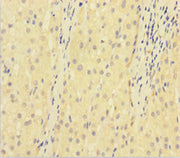 Immunohistochemistry of paraffin-embedded human liver cancer using CSB-PA07279A0Rb at dilution of 1:100