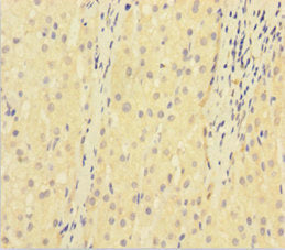 Immunohistochemistry of paraffin-embedded human liver cancer using CSB-PA07279A0Rb at dilution of 1:100