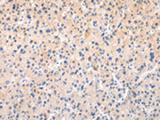 The image on the left is immunohistochemistry of paraffin-embedded Human liver cancer tissue using CSB-PA072803(APLN Antibody) at dilution 1/20, on the right is treated with synthetic peptide. (Original magnification: ×200)