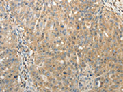 The image on the left is immunohistochemistry of paraffin-embedded Human ovarian cancer tissue using CSB-PA072816(SULT1E1 Antibody) at dilution 1/30, on the right is treated with fusion protein. (Original magnification: ×200)