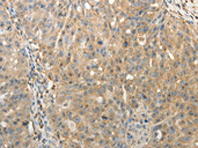 The image on the left is immunohistochemistry of paraffin-embedded Human ovarian cancer tissue using CSB-PA072816(SULT1E1 Antibody) at dilution 1/30, on the right is treated with fusion protein. (Original magnification: ×200)
