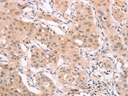 The image on the left is immunohistochemistry of paraffin-embedded Human breast cancer tissue using CSB-PA072901(ADAM11 Antibody) at dilution 1/40, on the right is treated with synthetic peptide. (Original magnification: ×200)