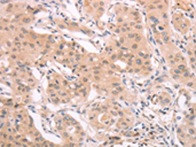 The image on the left is immunohistochemistry of paraffin-embedded Human breast cancer tissue using CSB-PA072901(ADAM11 Antibody) at dilution 1/40, on the right is treated with synthetic peptide. (Original magnification: ×200)