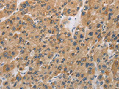 The image on the left is immunohistochemistry of paraffin-embedded Human liver cancer tissue using CSB-PA072935(CYFIP2 Antibody) at dilution 1/25, on the right is treated with fusion protein. (Original magnification: ×200)