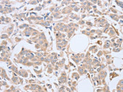 The image on the left is immunohistochemistry of paraffin-embedded Human breast cancer tissue using CSB-PA072974(ABHD5 Antibody) at dilution 1/10, on the right is treated with fusion protein. (Original magnification: ×200)