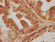 IHC image of CSB-PA07309A0Rb diluted at 1:600 and staining in paraffin-embedded human prostate cancer performed on a Leica BondTM system. After dewaxing and hydration, antigen retrieval was mediated by high pressure in a citrate buffer (pH 6.0). S...