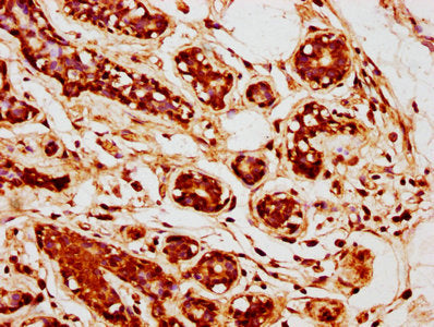 IHC image of CSB-PA07315A0Rb diluted at 1:400 and staining in paraffin-embedded human breast cancer performed on a Leica BondTM system. After dewaxing and hydration, antigen retrieval was mediated by high pressure in a citrate buffer (pH 6.0). Sec...